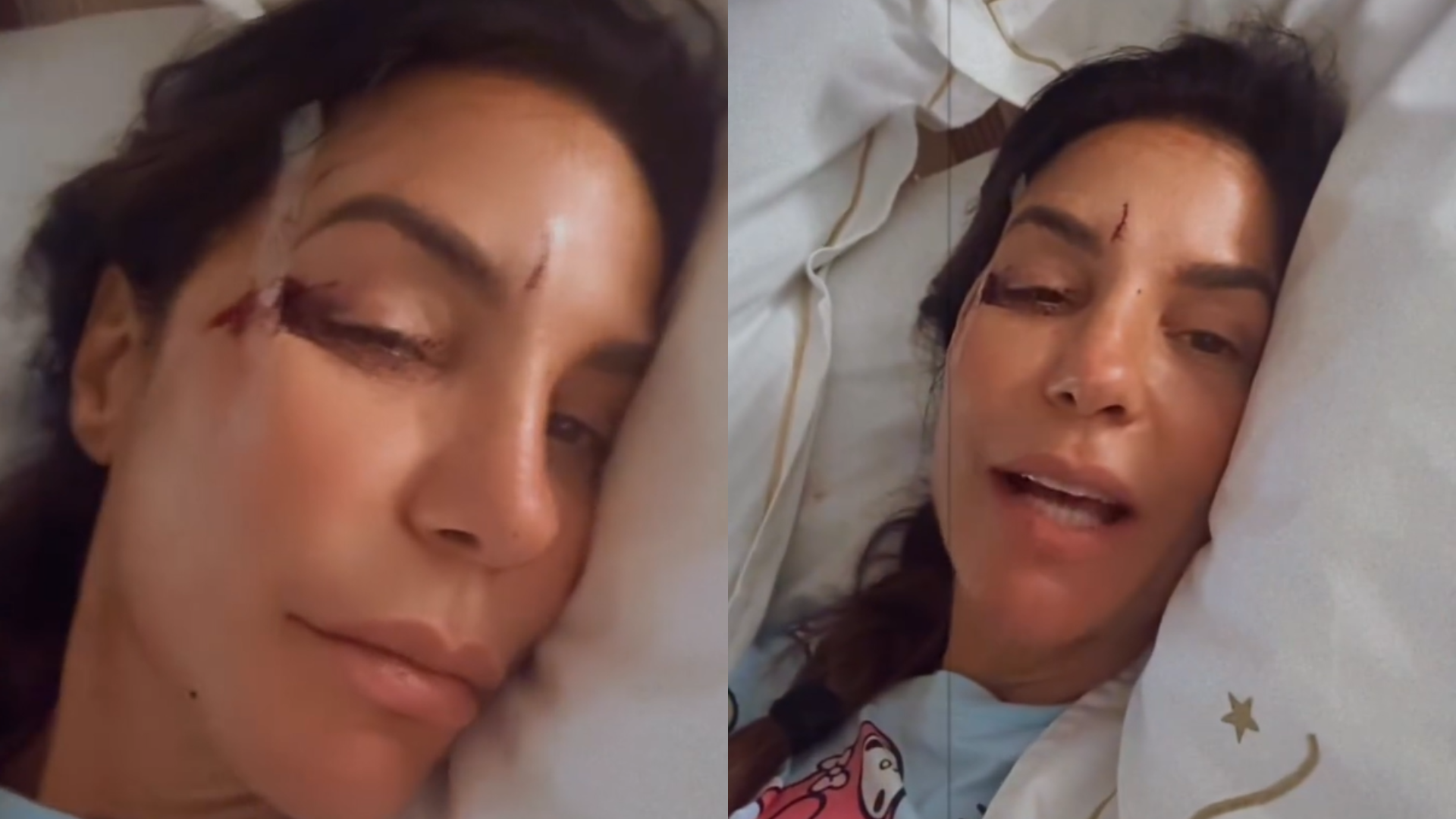 Ivete Sangalo mostrou machucados ap&oacute;s cair no banheiro de casa | Imagens: reprodu&ccedil;&atilde;o/Instagram