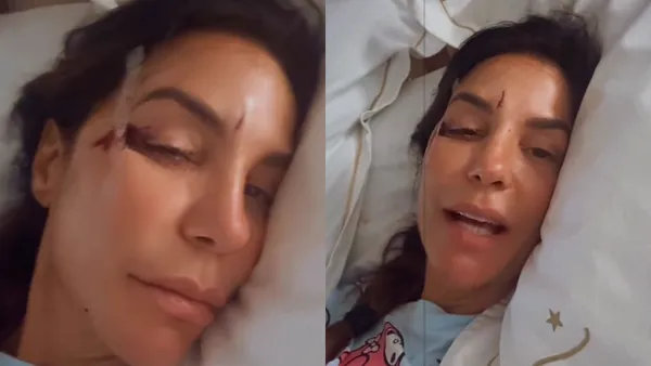 Ivete Sangalo mostrou machucados após cair no banheiro de casa | Imagens: reprodução/Instagram