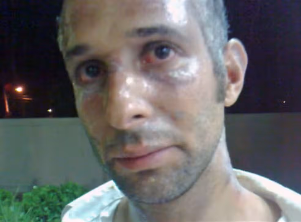 Márcio Costa Com Queimaduras No Rosto Em 2011 Reprodução