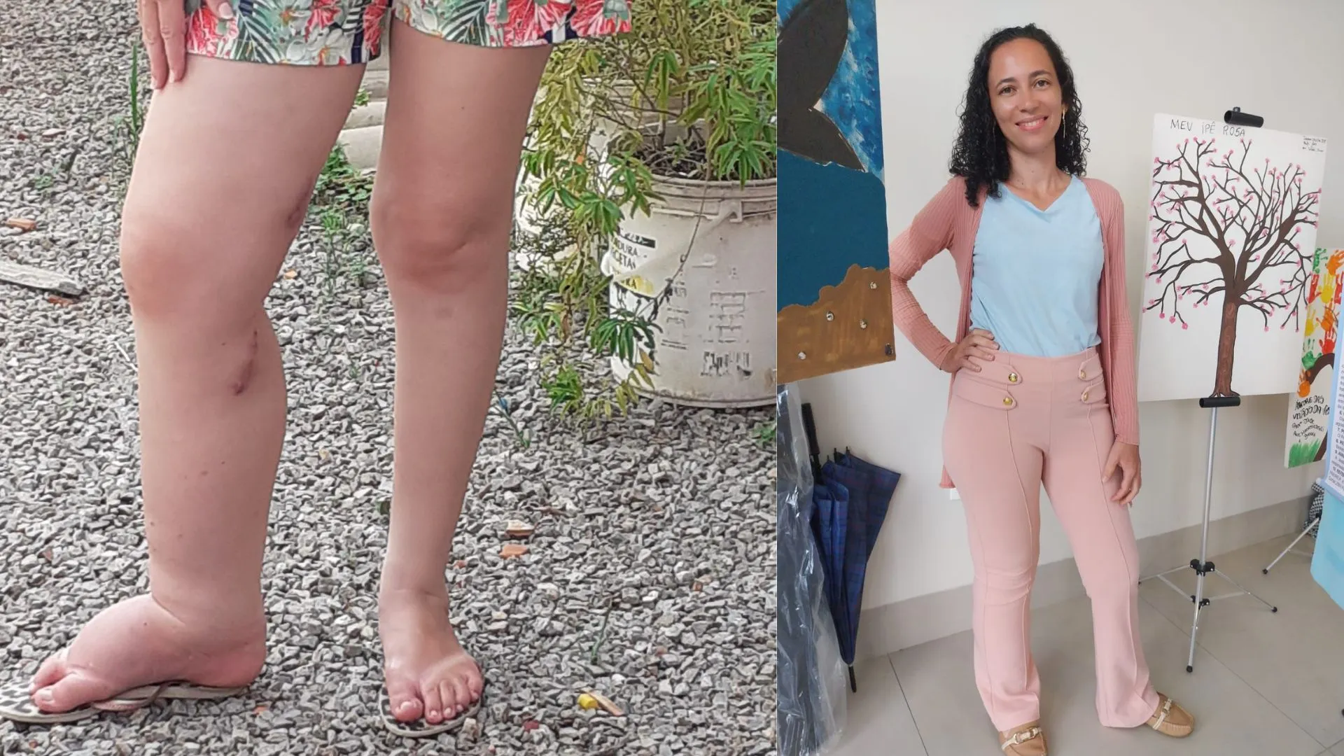 Paciente com linfedema celebra após transplante raro feito na Bahia