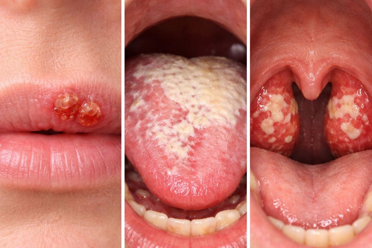 Olha a boca! Especialista alerta para cuidados com a sa&uacute;de bucal no Carnaval. Foto: Divulga&ccedil;&atilde;o