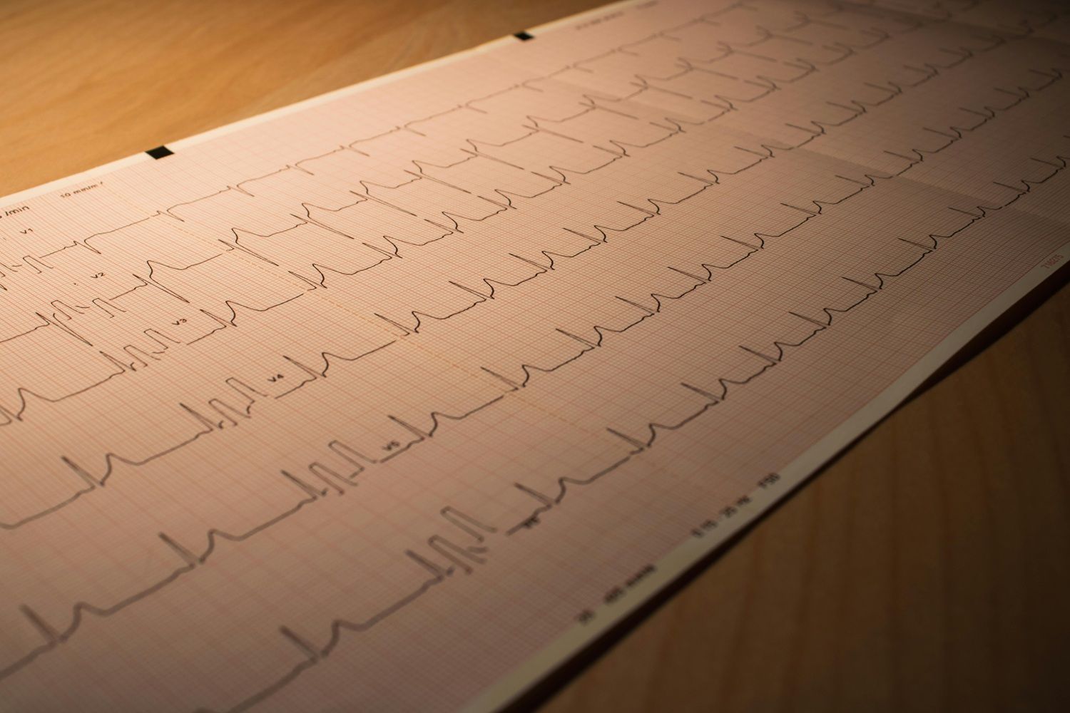No Brasil, o infarto agudo do miocárdio (IAM) é a principal causa de morte entre as doenças cardiovasculares. | Foto: Ilustrativa/Pexels