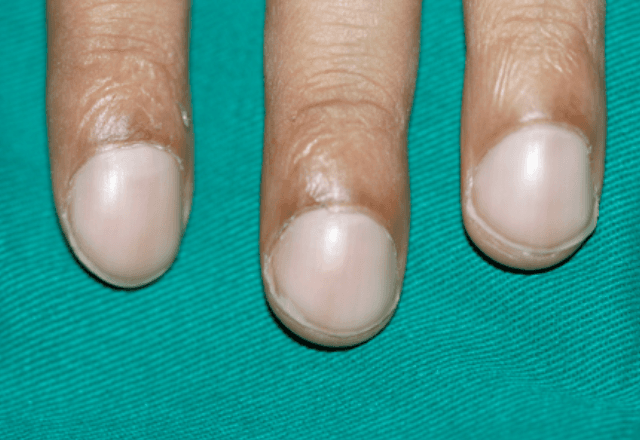 Unhas com sinais de baqueteamento. | Foto: Murlidhar Rajagopalan/BMJ