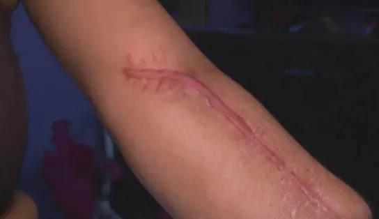 Após entrar para dar à luz, mulher tem mão amputada em hospital; "estou me refazendo" 