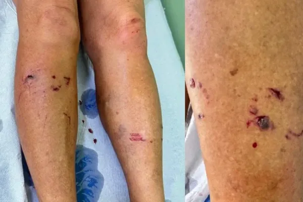 Raposa ataca mulher na Bahia; cidade registra três casos em duas semanas