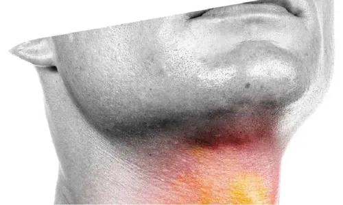 Câncer de Cabeça e Pescoço. Foto: Ilustração | Oncoprime