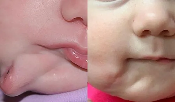 Bebê é submetida a cirurgia após nascer com duas bocas; apenas 35 casos do tipo foram registrados desde 1900 