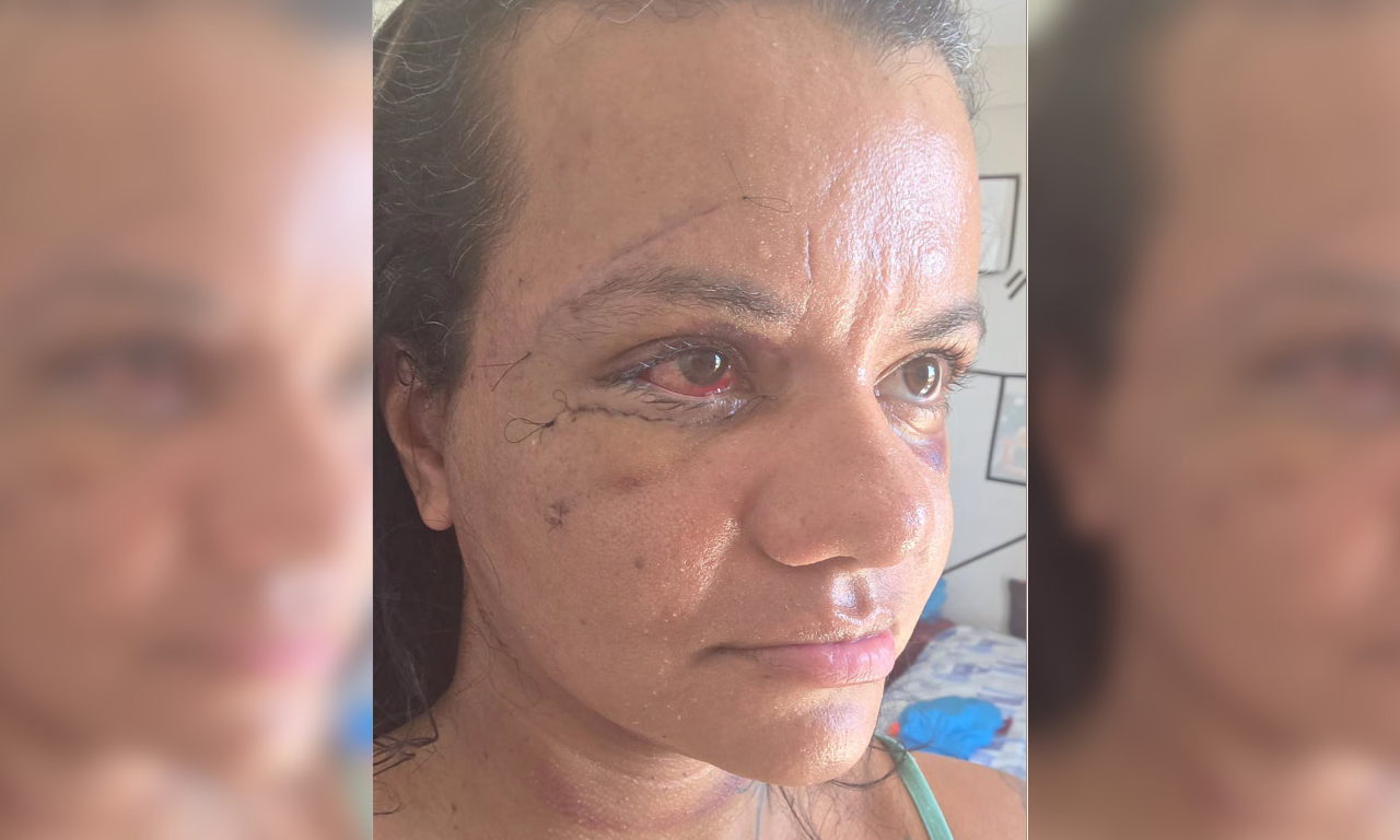 Mulher agredida com mais de 60 socos mostra rosto após cirurgia facial.Foto: TV Aratu 