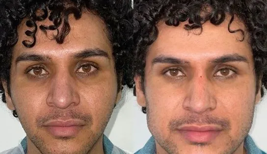 Baiano viraliza nas redes sociais após promover "chá de harmonização facial"; confira vídeo