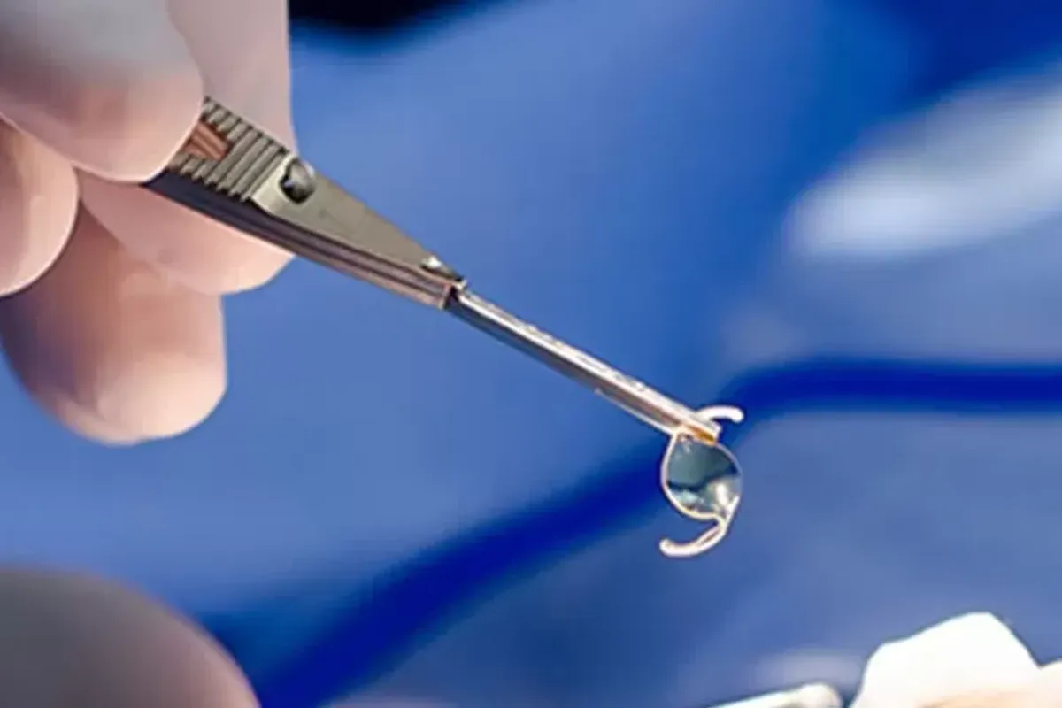 Cirurgia de catarata serve para restaurar nitidez da vis&atilde;o. Foto: Ilustra&ccedil;&atilde;o