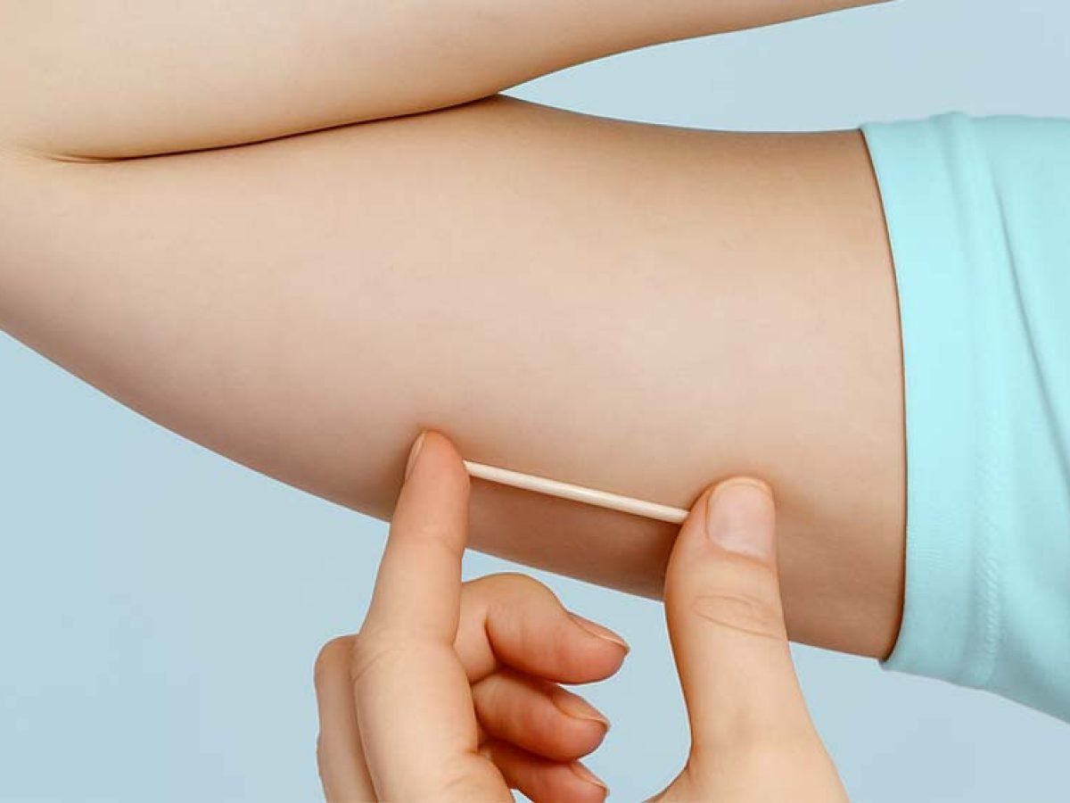 A aplicação é realizada por um médico, em procedimento simples com anestesia local. | Foto: Divulgação