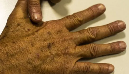 Brasil terá 704 mil novos casos de câncer por ano até 2025, diz Inca