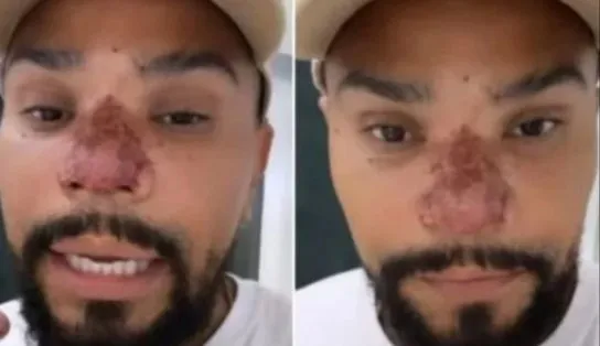 Naldo Benny sofre com necrose no nariz após rinomodelação; médico explica o que pode ter acontecido