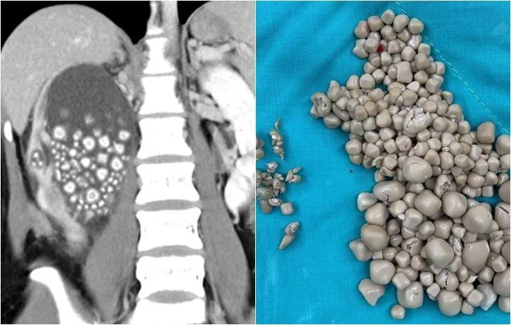 Jovem é diagnosticada com mais de 300 pedras nos rins