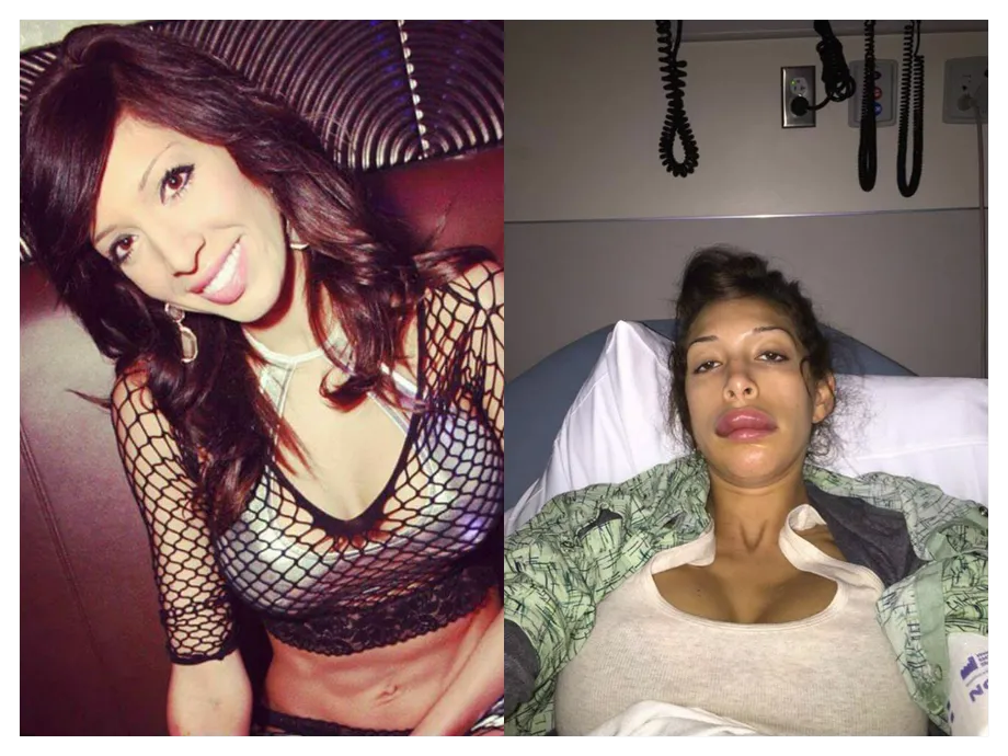 Atriz pornô fica quase irreconhecível após cirurgia nos lábios