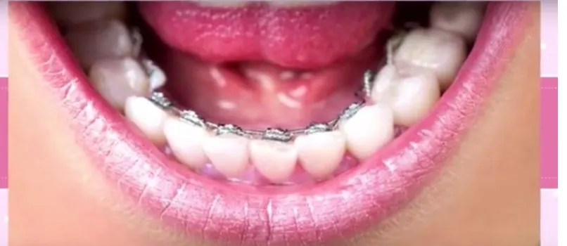 DICAS DA BARBIE: Conheça o aparelho ‘invisível’ para corrigir os dentes e manter a boa aparência