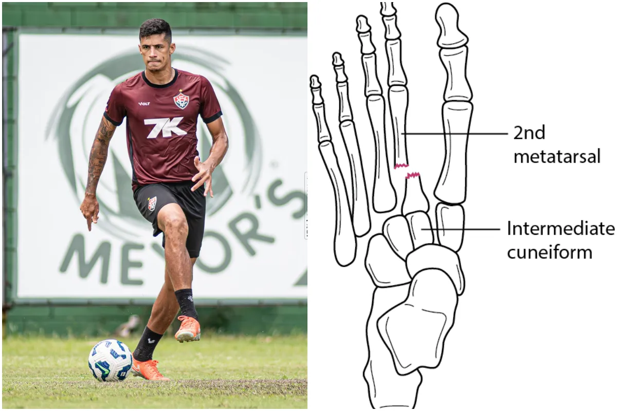 Diagnósticado com fratura no pé, Camutanga será operado na próxima semana