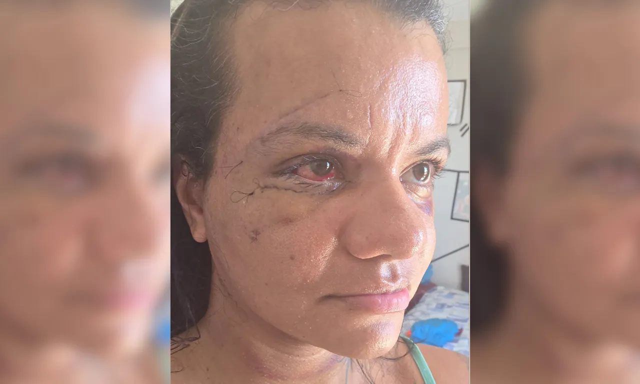 Mulher agredida com mais de 60 socos mostra rosto após cirurgia facial