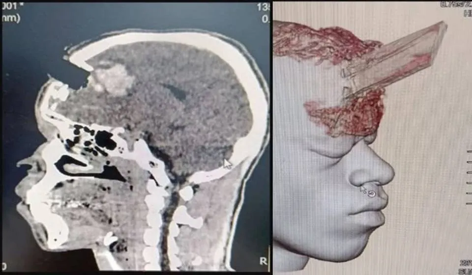 Durante serviço, estaca atravessa cabeça de pedreiro e objeto é retirado em cirurgia; saiba mais