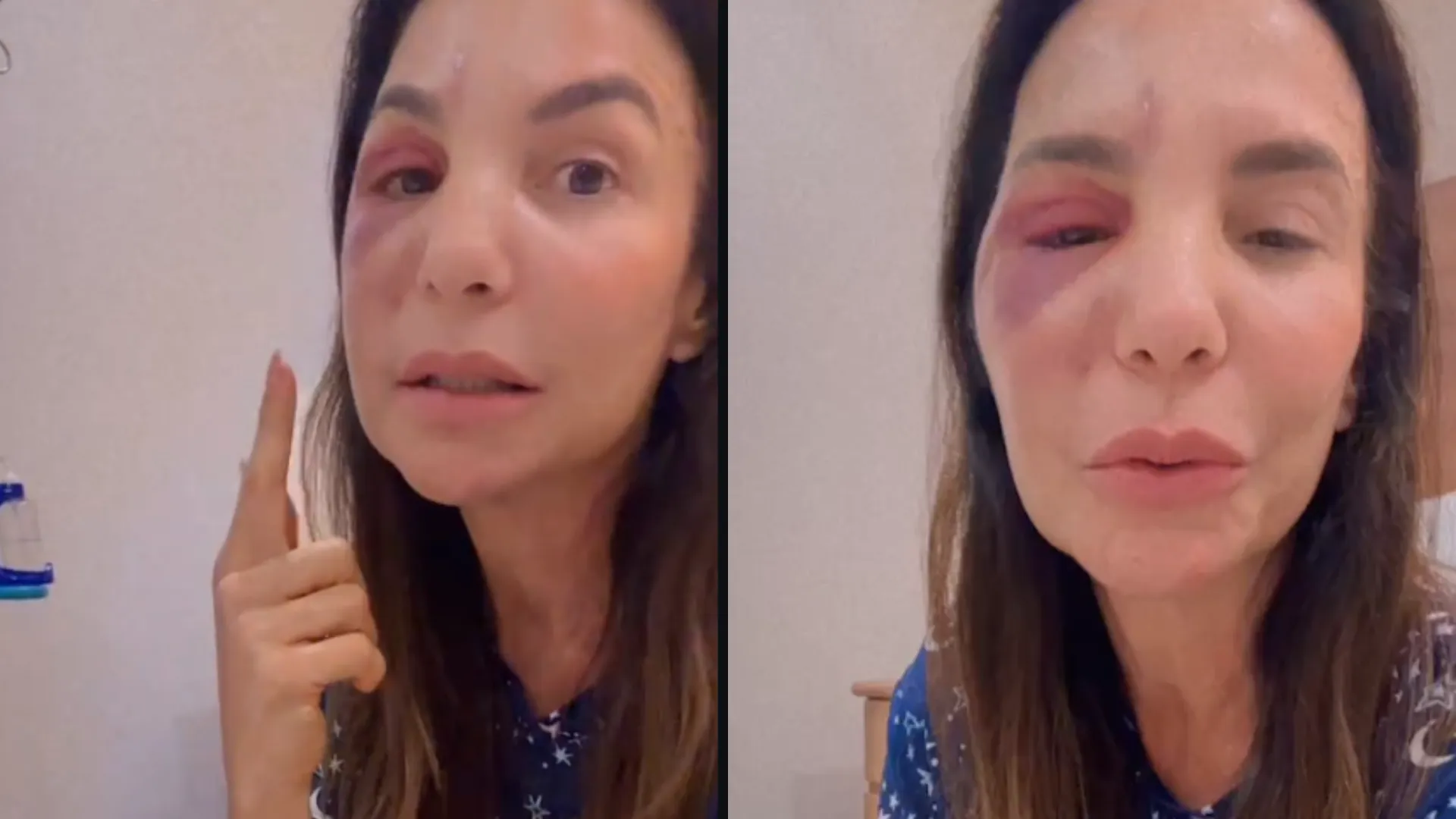 Ivete Sangalo explicou cirurgia em live no Instagram