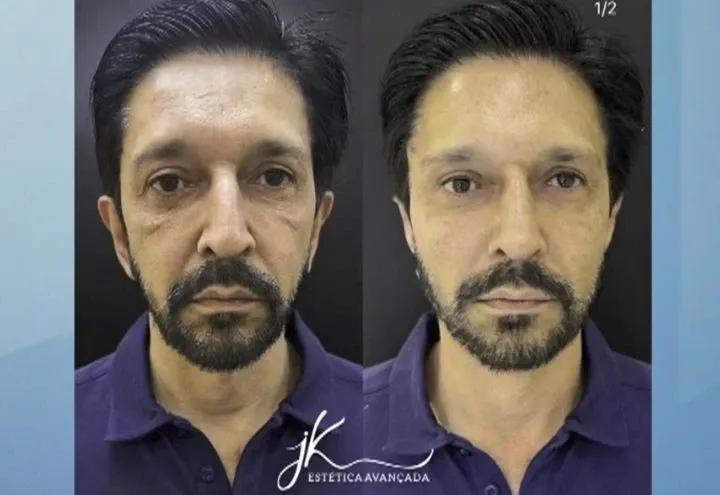 Harmonização facial de Ricardo Nunes (MDB) pode motivar investigação