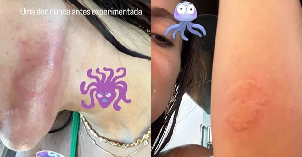 Anitta revela dor após queimadura por água-viva na Espanha: 'Experiência de ser eletrocutada'