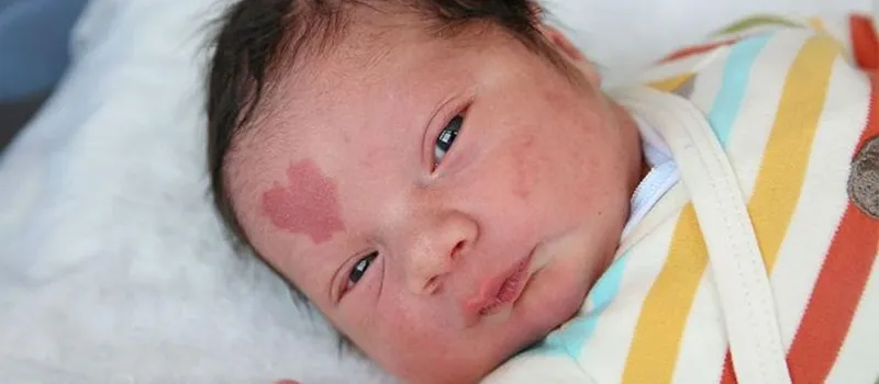 BEBÊ DO AMOR: Conheça a criança que nasceu com um sinal em forma de coração na testa