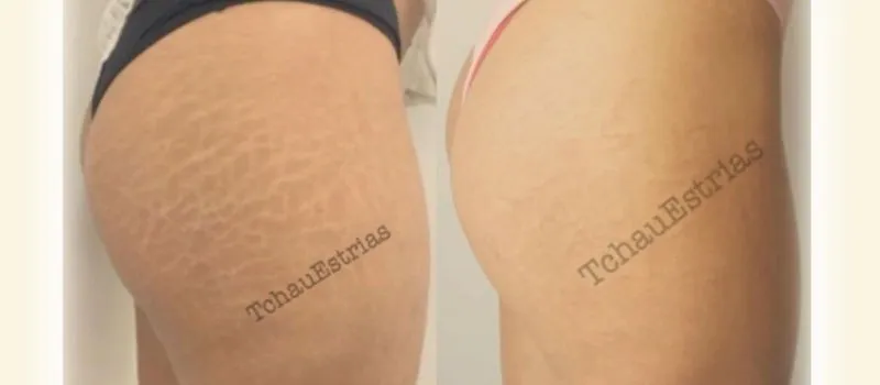 NÃO É MÁGICA: Brasileiro descobre forma de acabar com todas as estrias em mulheres