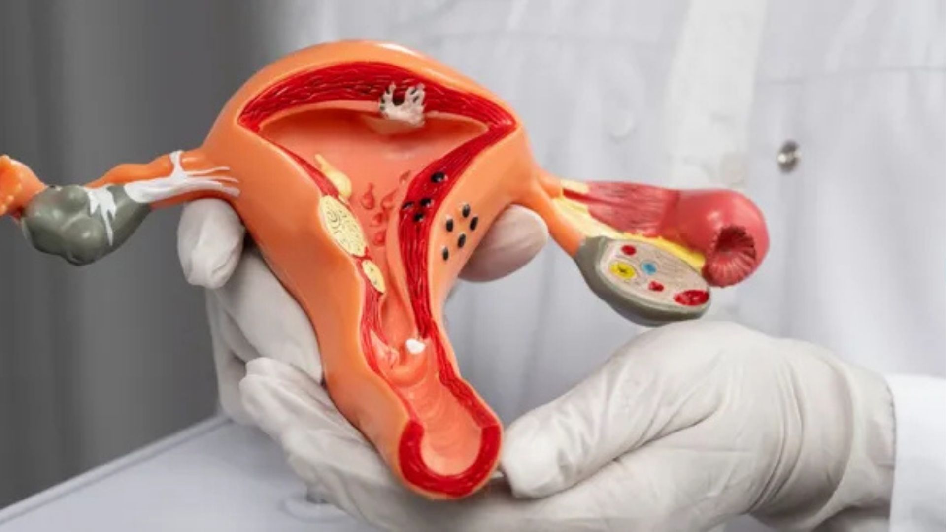 Planos de sa&uacute;de ter&atilde;o de cobrir DIU para endometriose a partir de outubro; Foto: Freepik