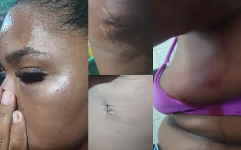 Devido &agrave;s les&otilde;es aparentes apresentadas a mulher foi encaminha inicialmente para uma Unidade de Pronto Atendimento (UPA)/Foto: Reprodu&ccedil;&atilde;o/Redes Sociais&nbsp;