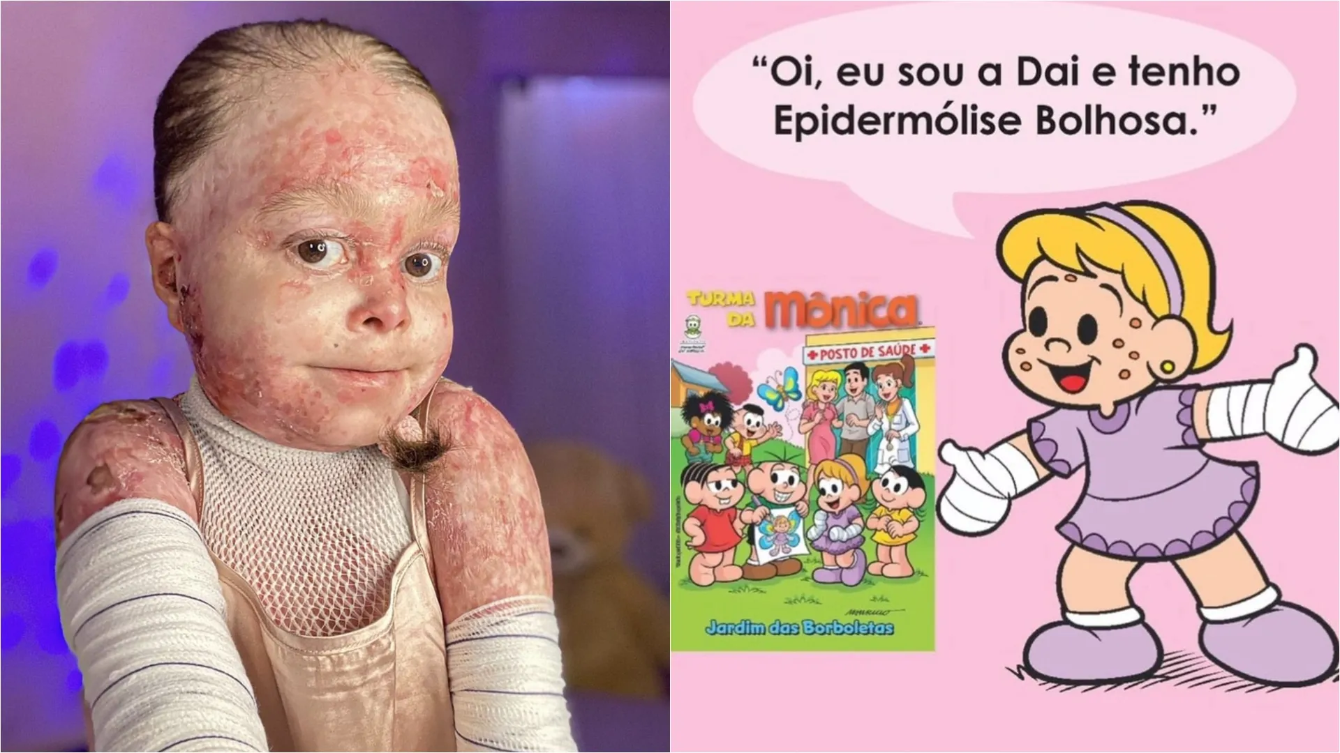 Baiana portadora de doença rara vira personagem da Turma da Mônica