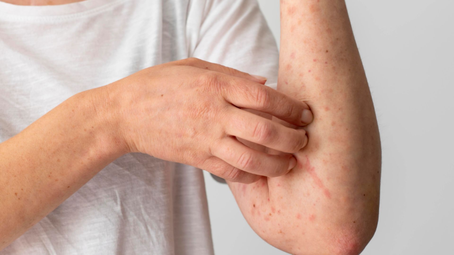 Casos de Mpox na Bahia. Foto: Freepik