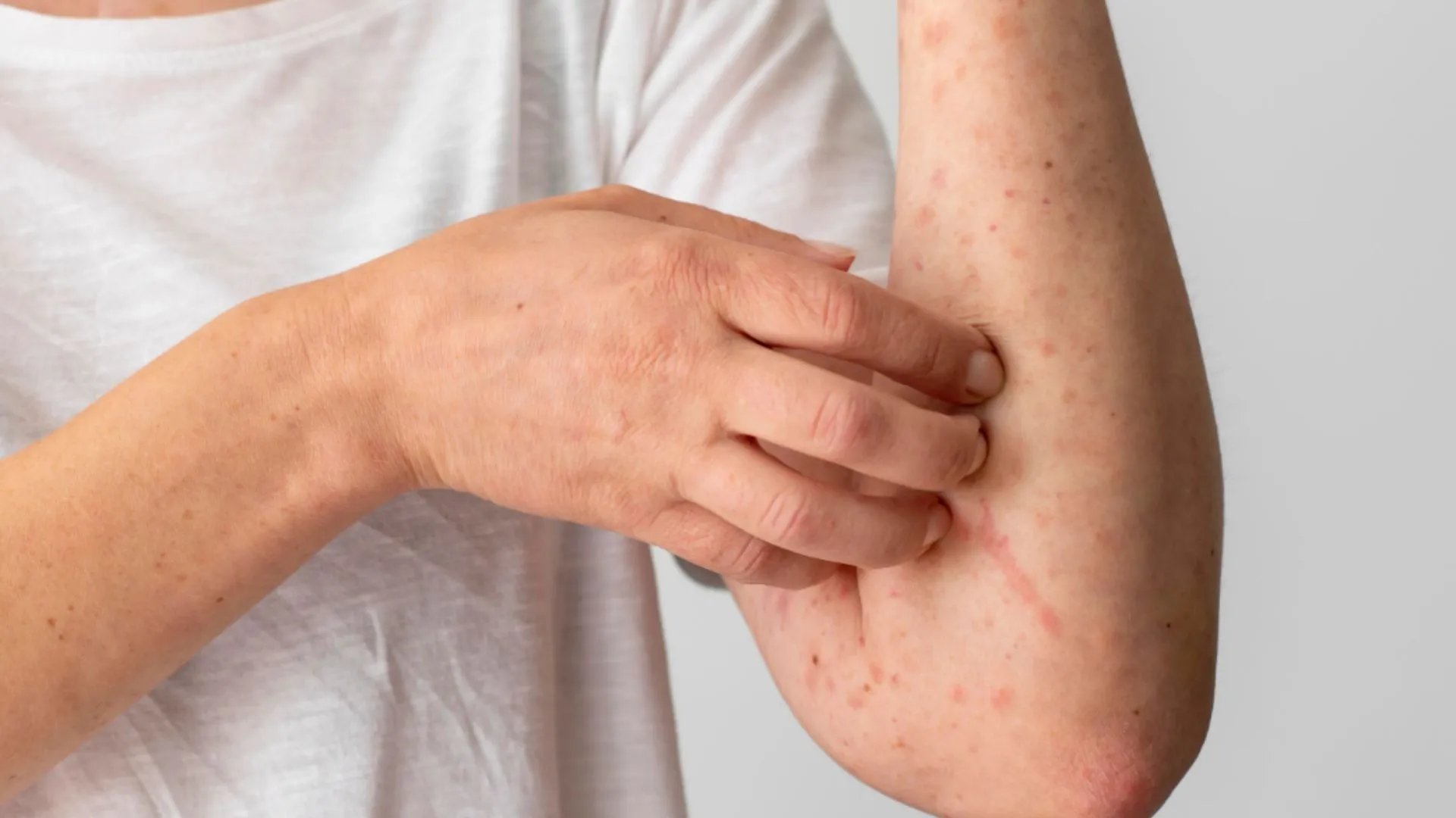 Quantos casos de Mpox a Bahia confirmou até agora? Veja cenário atual