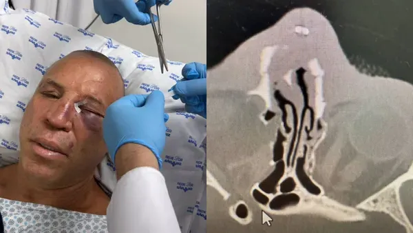 utador quebrou o nariz e foi levado a hospital | Imagens: redes sociais