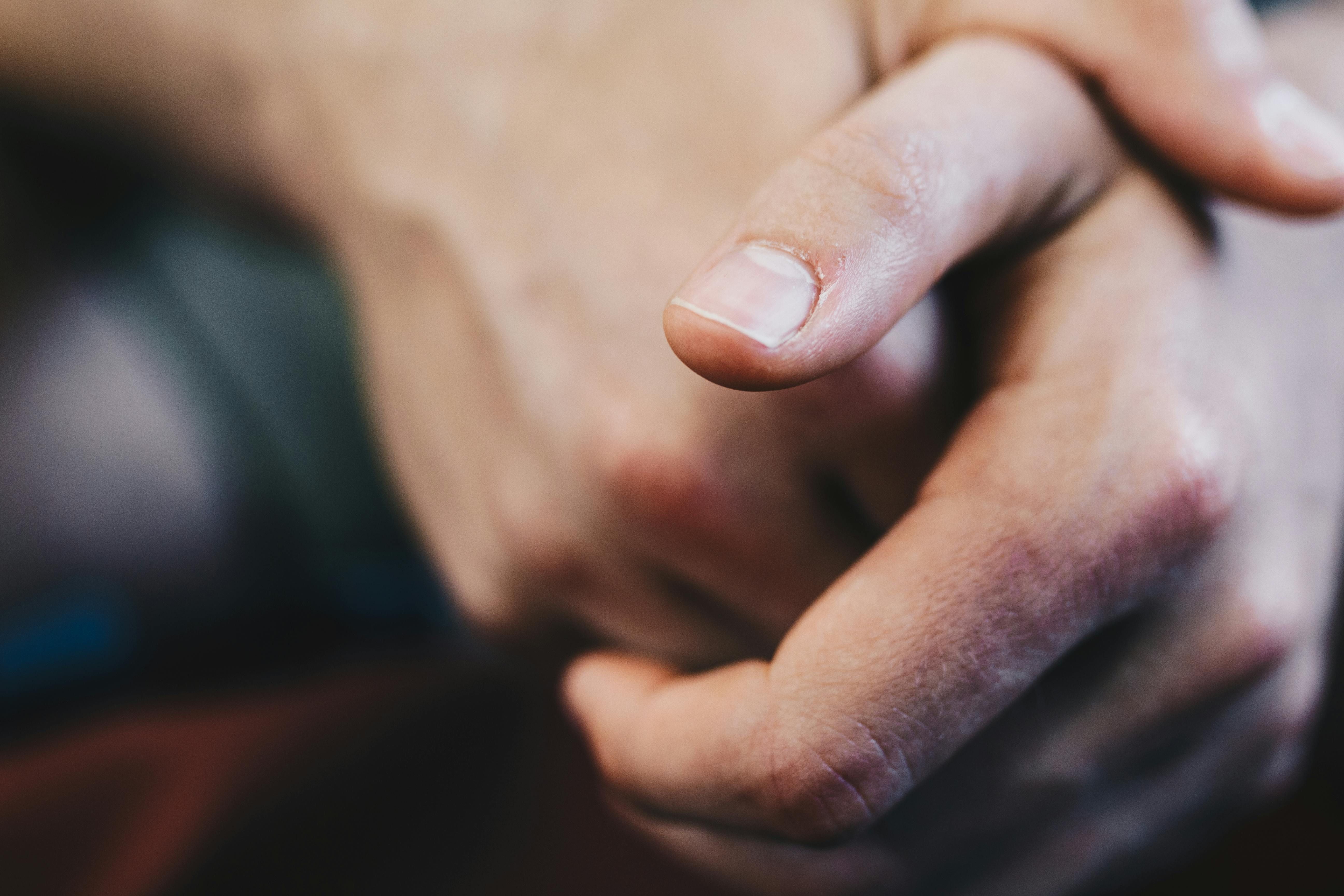 Com o tempo, as unhas se curvam acentuadamente e os dedos ganham aspecto arredondado e inchado. | Foto: Ilustrativa/Pexels