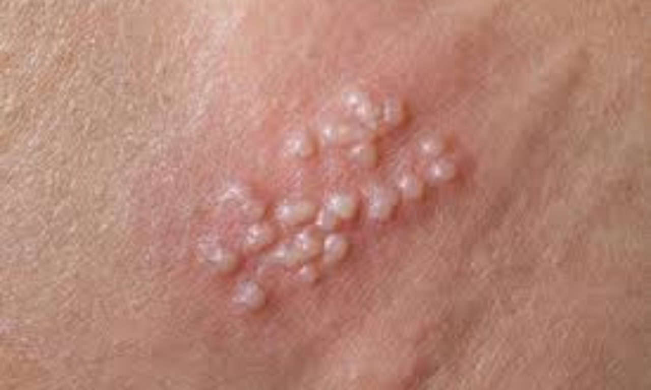 Infecções sexualmente transmissíveis (ISTs) podem ser uma das causas.Foto: Reprodução