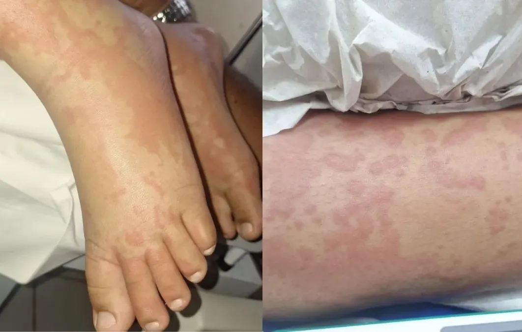 Criança é internada após suspeita de contaminação por detergente Ypê