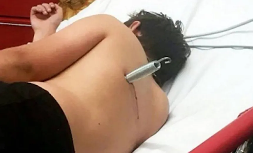 Defeito em cama elástica deixa adolescente com mola cravada nas costas