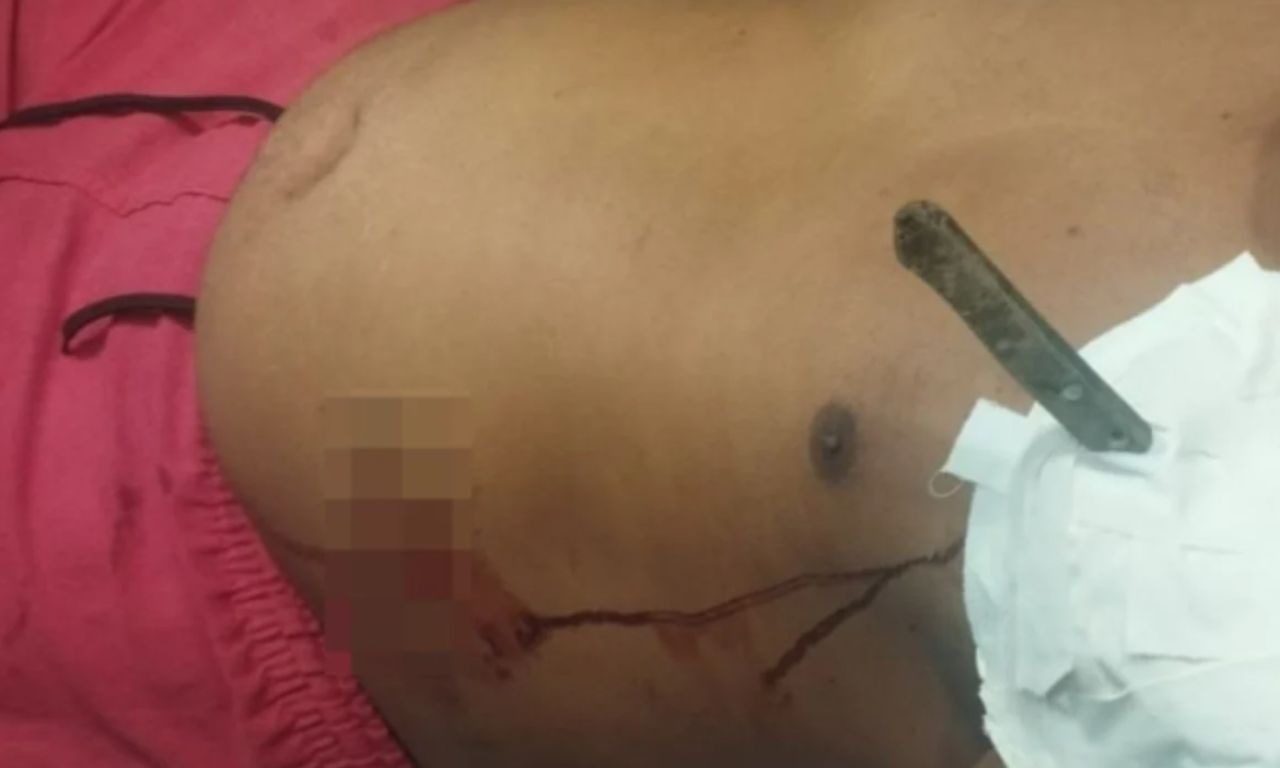 Homem Fica Com Faca Cravada No Corpo