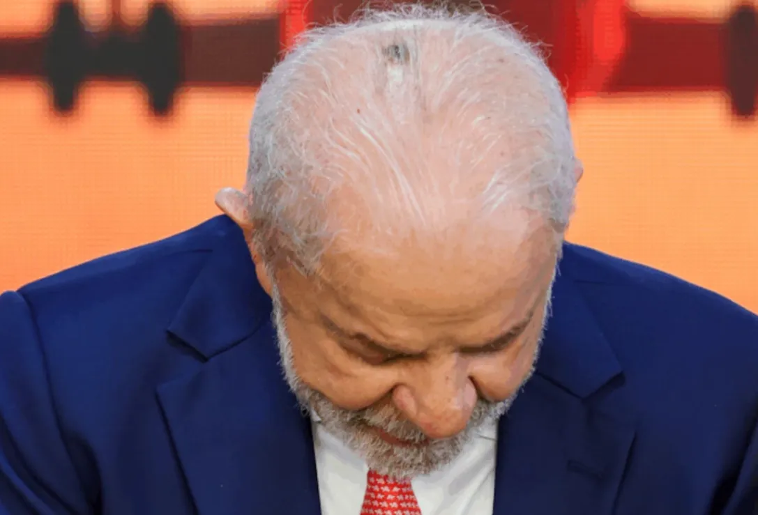 Entenda o que é a radioterapia preventiva iniciada por Lula após cirurgia
