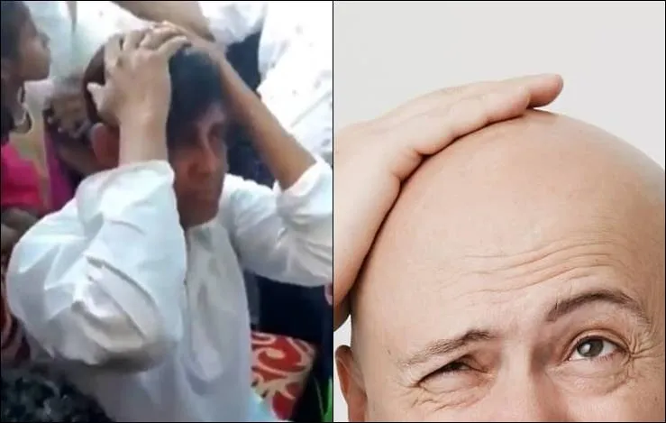 É dos carecas que elas gostam? Noivo é agredido por família de esposa ao descobrirem careca
