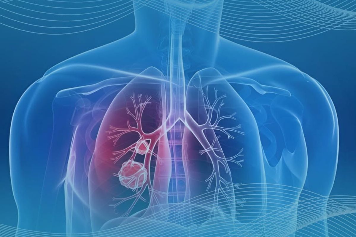 Adenocarcinoma Pulmonar. Foto: Ilustrativa