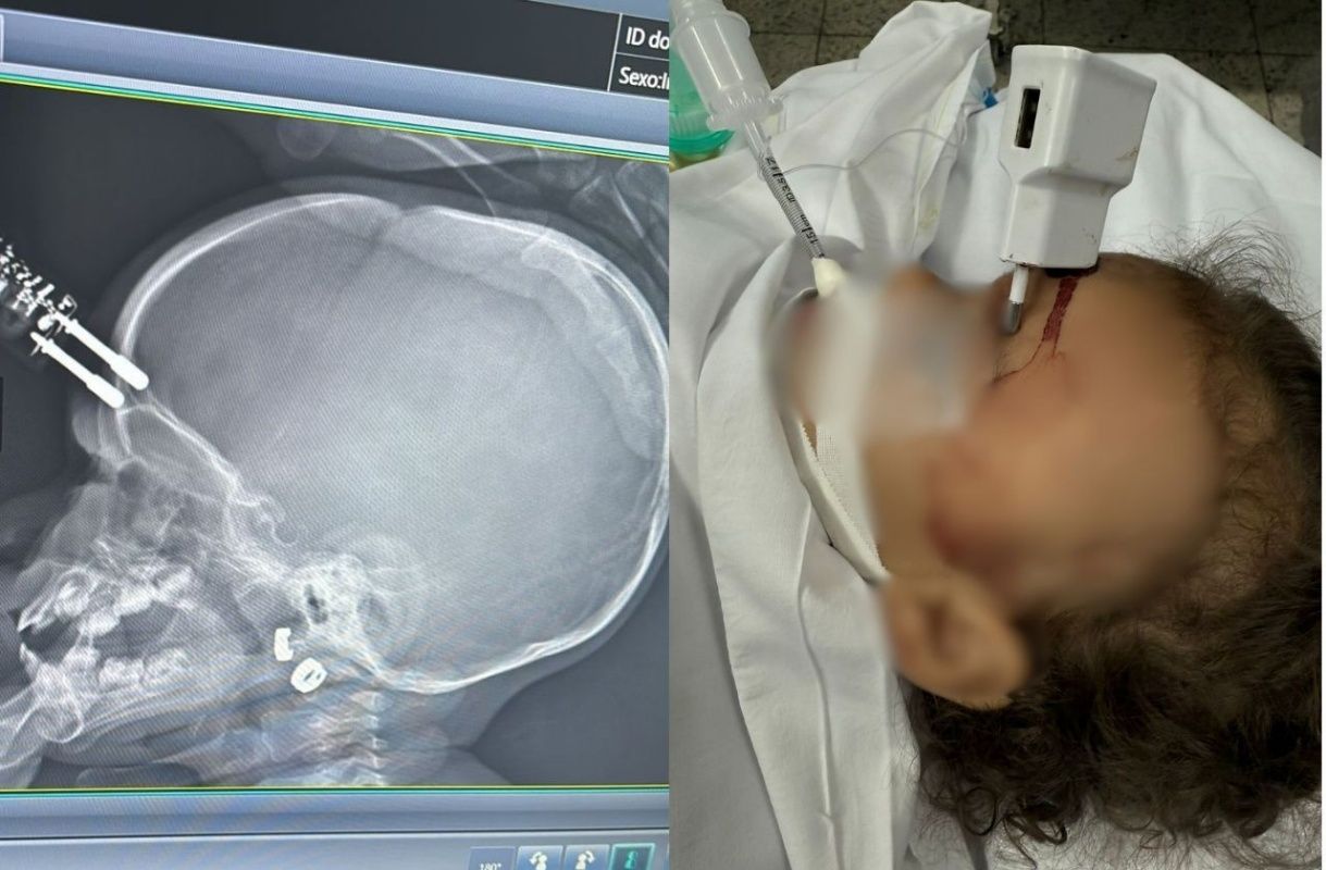 A beb&ecirc; ficou com um carregador de celular preso na testa ap&oacute;s cair de uma cama e precisou passar por uma cirurgia de emerg&ecirc;ncia. Foto: SBT News