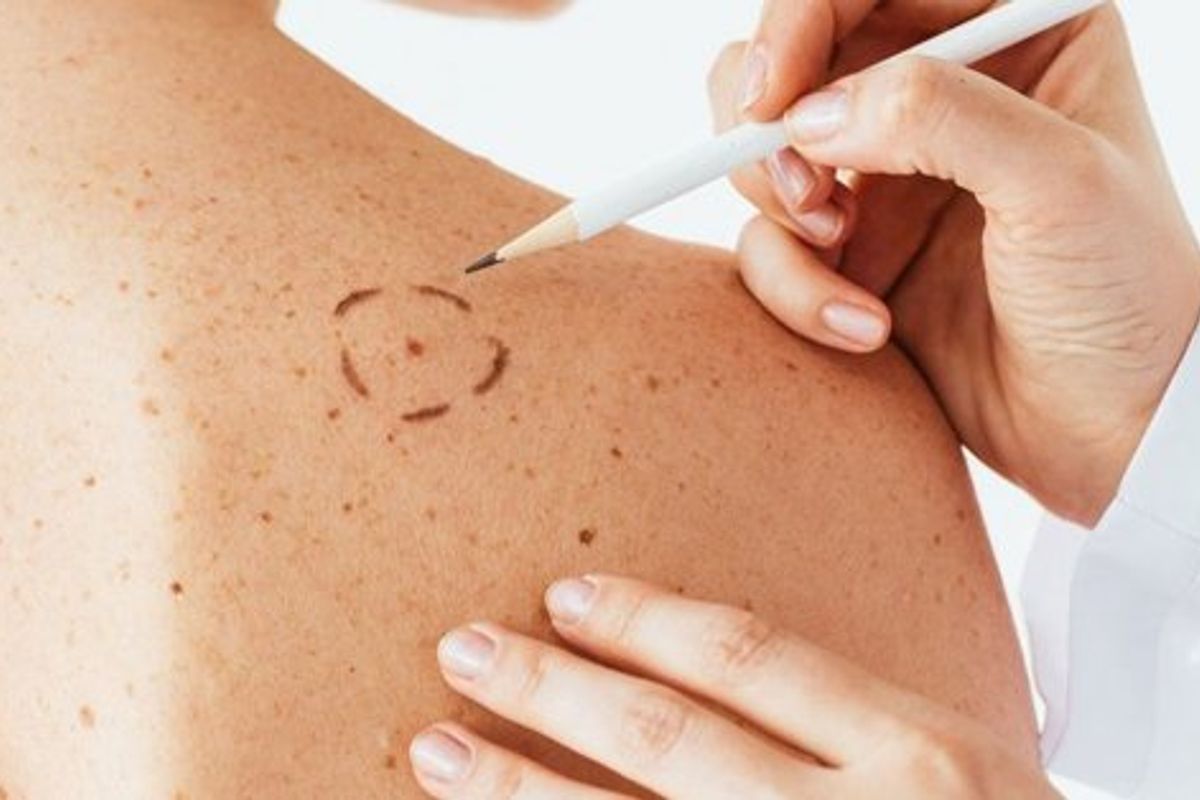 Inteligência artificial pode detectar câncer de pele com 94,5% de precisão.|  Foto: Ilustrativa 