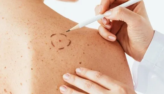 Dermatologistas alertam sobre o melanoma, câncer de pele mais agressivo; confira cuidados e fatores de risco