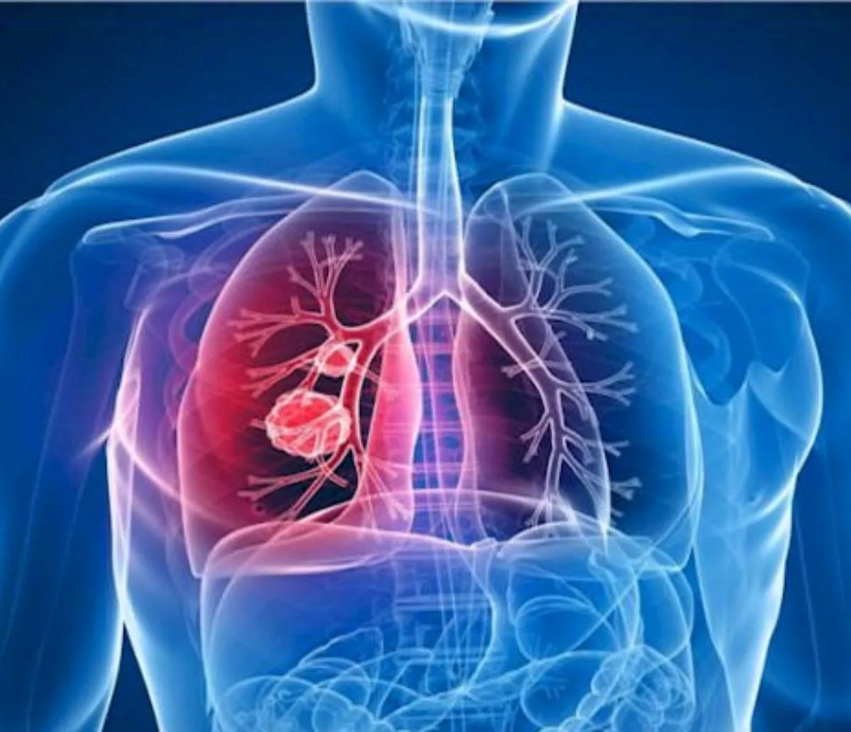 Dia Mundial da Tuberculose: Redes de tratamento precisam de mais investimentos, aponta especialista