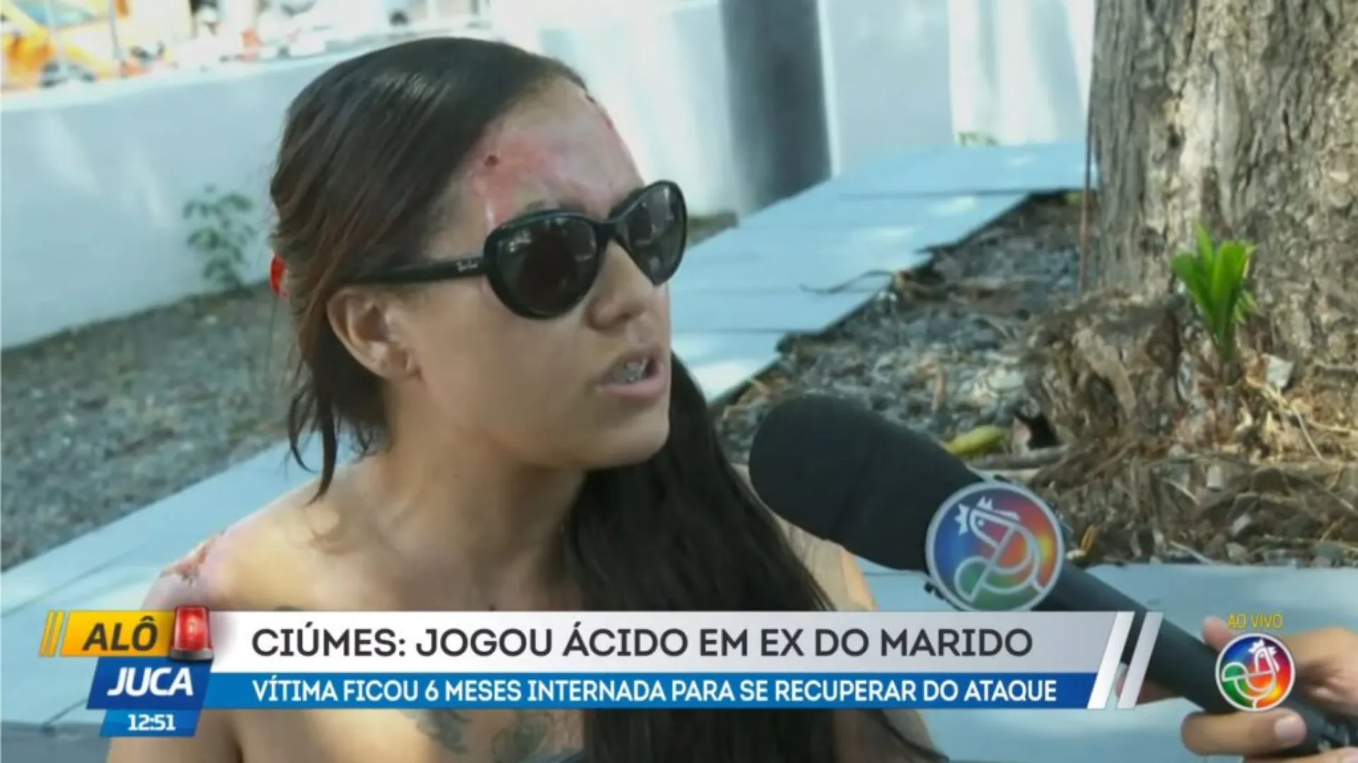 Vítima de queimadura com ácido 
