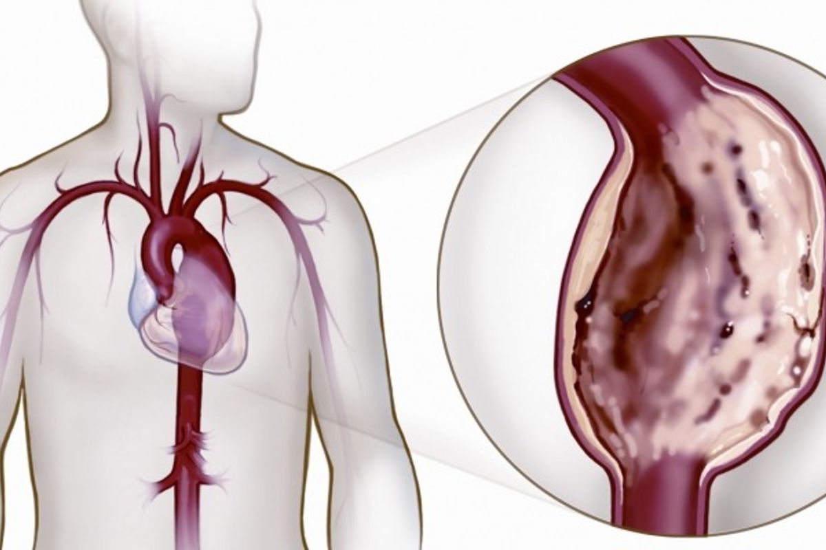 Aneurisma da Aorta. Foto: Ilustra&ccedil;&atilde;o | SBACV-SP
