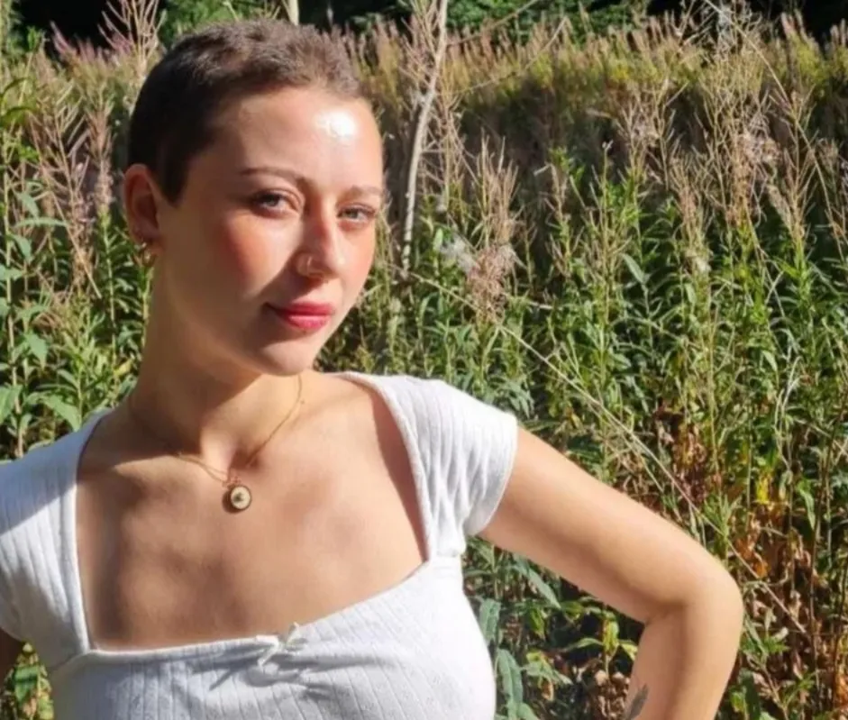 Jovem perde todo o cabelo por estresse no trabalho: 'Foi tudo muito rápido'