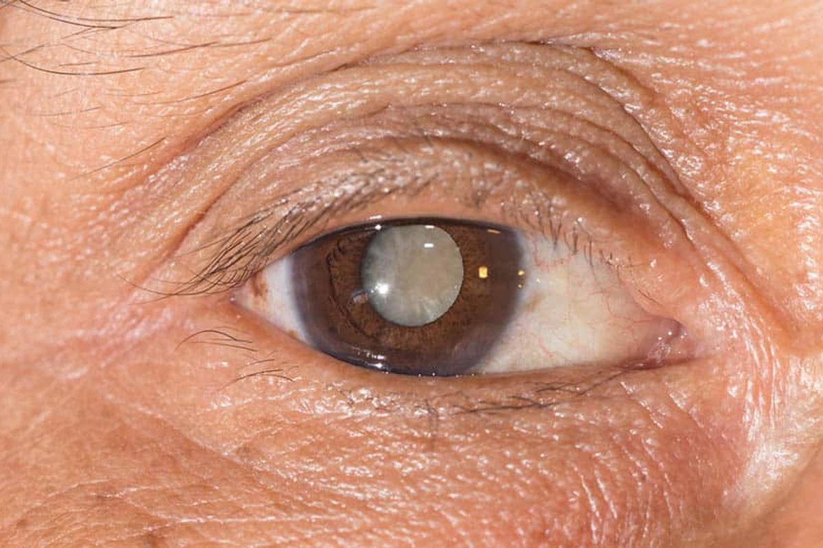 A catarata &eacute; uma doen&ccedil;a ocular caracterizada pela opacifica&ccedil;&atilde;o do cristalino. Foto: Ilustra&ccedil;&atilde;o